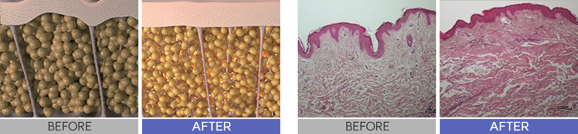 온다리프팅이미지