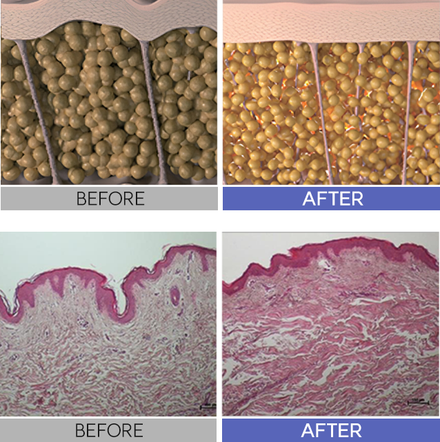 온다리프팅이미지